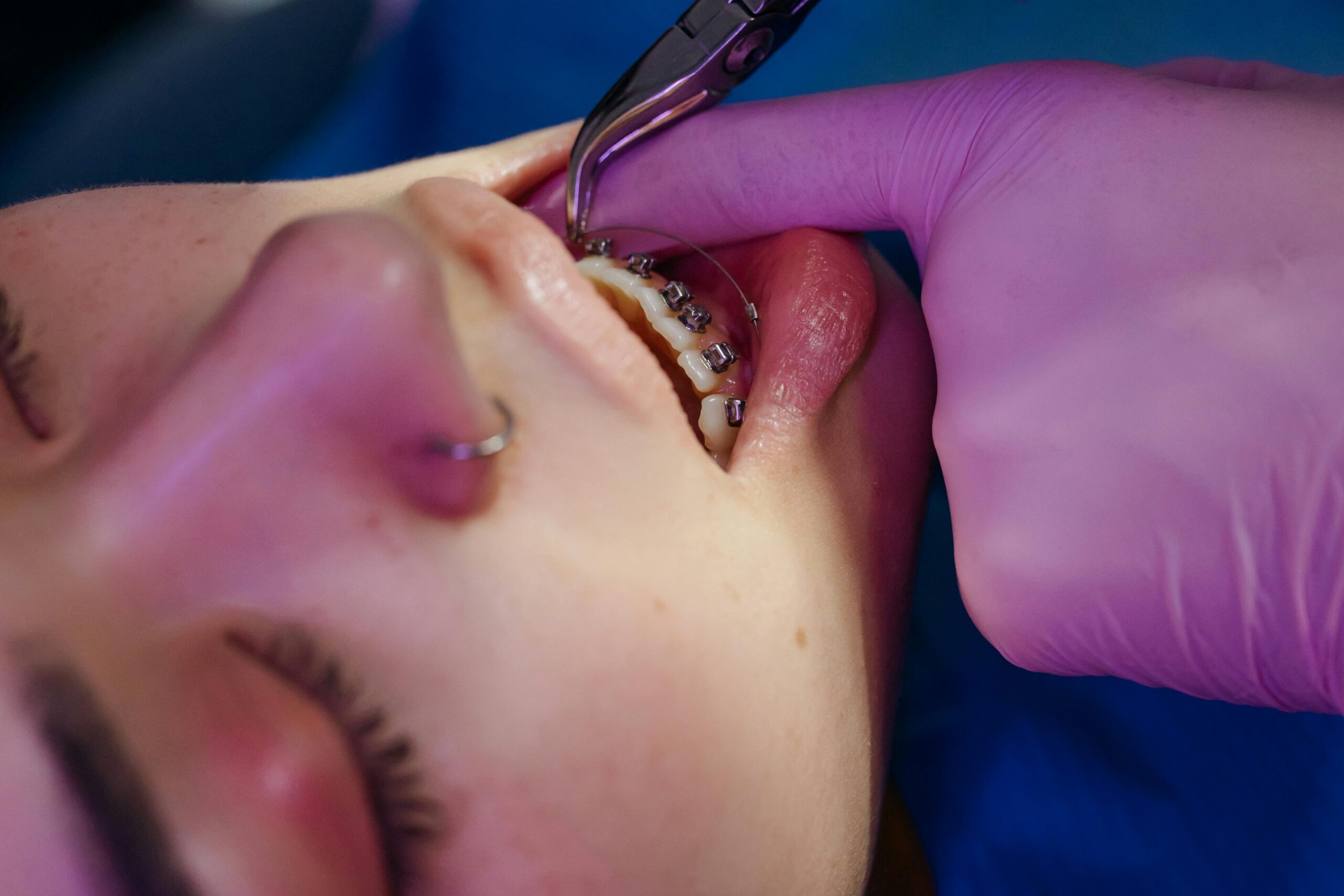 A close-up view of a dental procedure involving braces on a teen.